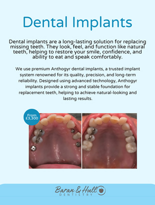 Dental Implants